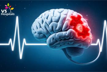 Brain Stroke: What You Must Know Before It’s Too Late